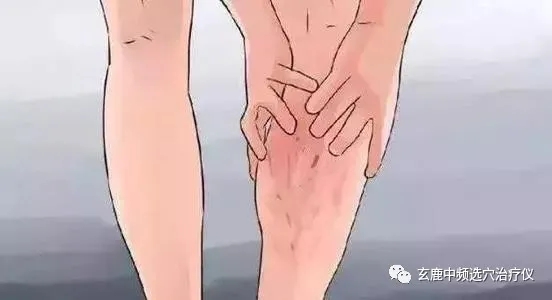 治療靜脈曲張，中醫(yī)有良方，一根針讓你告別“蚯蚓”腿